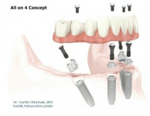 Dental Implant treatment only at 250$