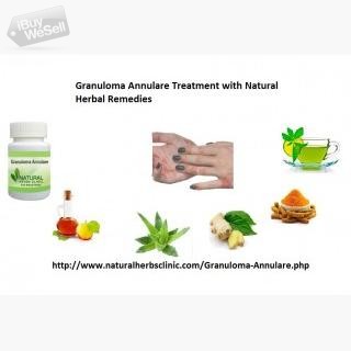 Granuloma Annulare Herbal Treatment