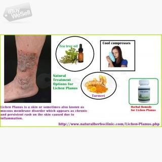 Treatment for Lichen PlCensored by Natural Herbs Clinic